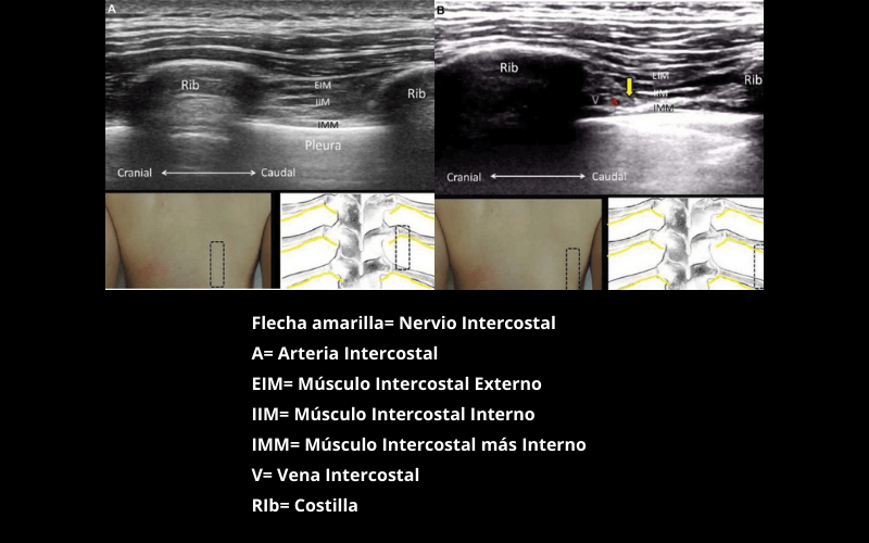 Nervio Intercostal (1).png